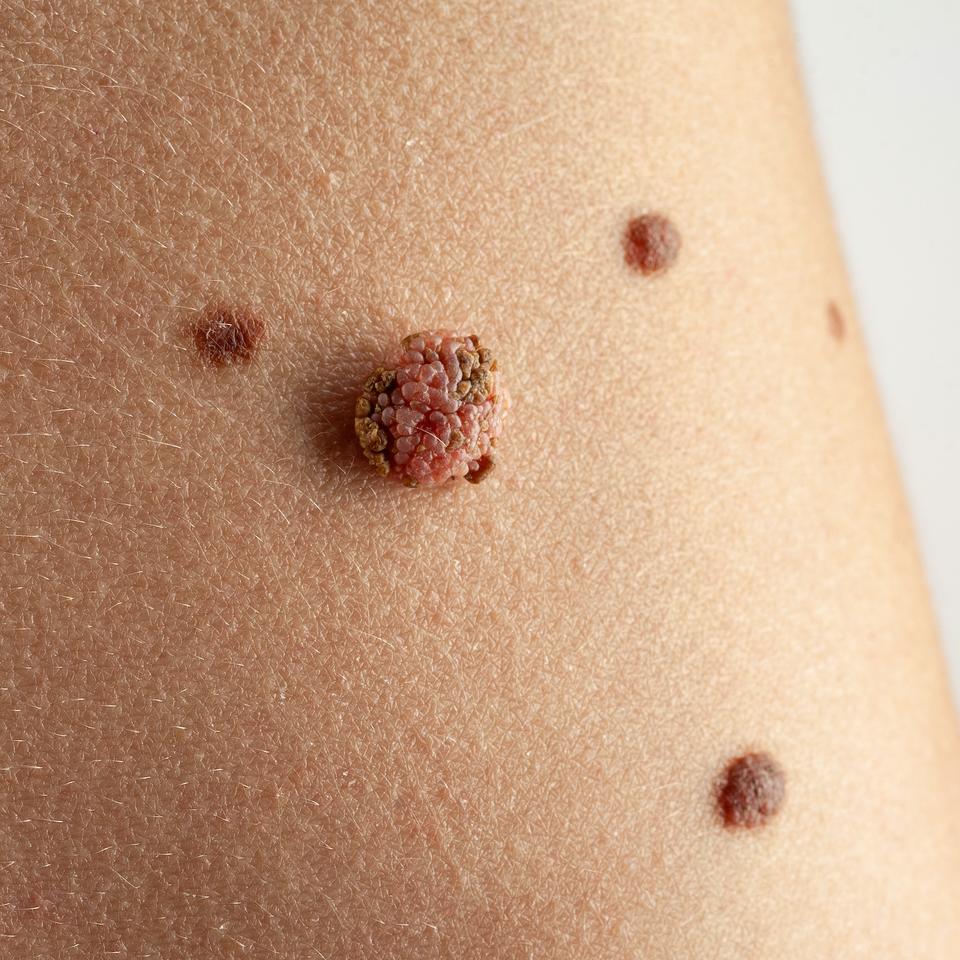 Quelle est la différence entre un carcinome et un mélanome — free download